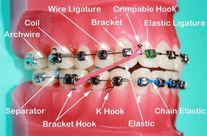 elastic tie braces