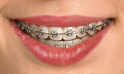 type-of-braces-2