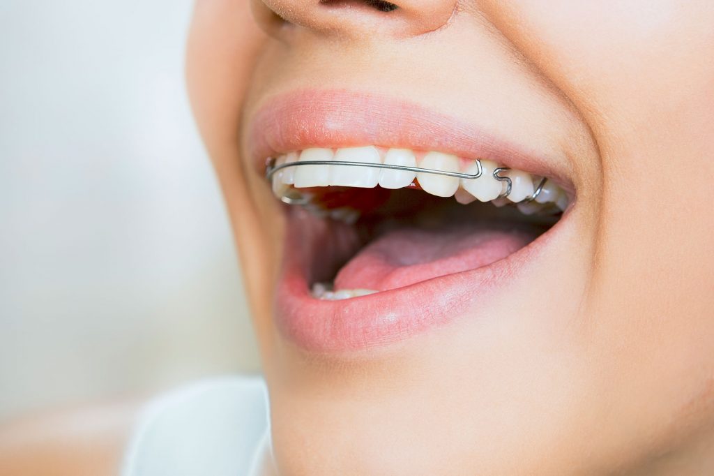 Do You Know The Parts Of Your Braces? (And Why It's Important)